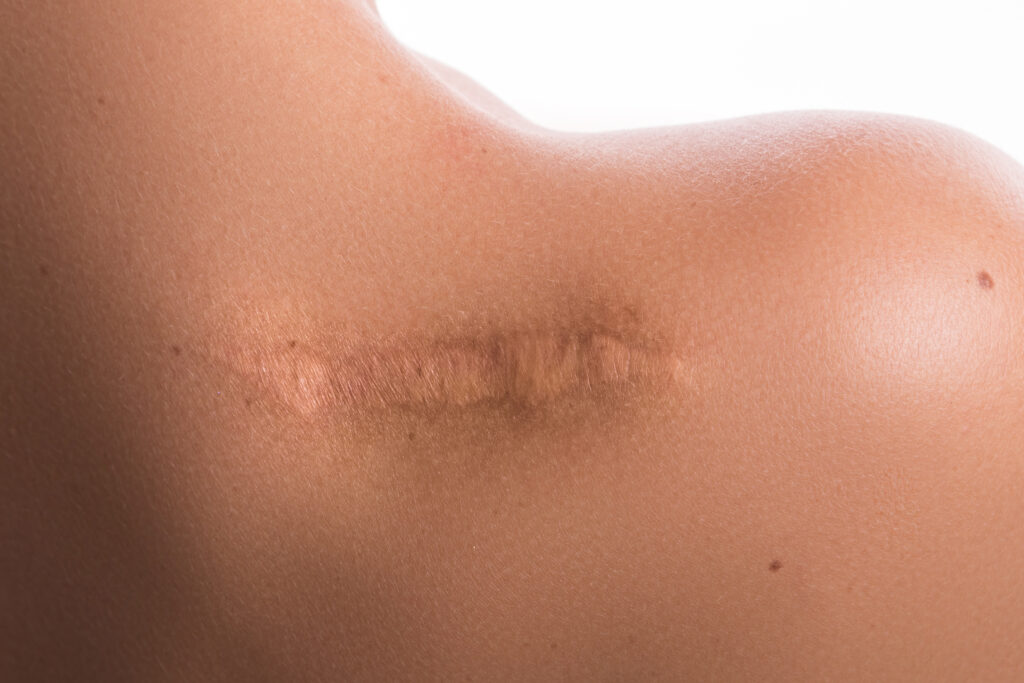 Scar Rejuvenation - Small Area