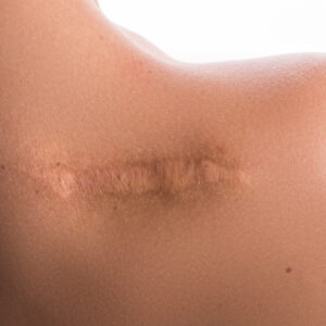 Scar Rejuvenation - Small Area